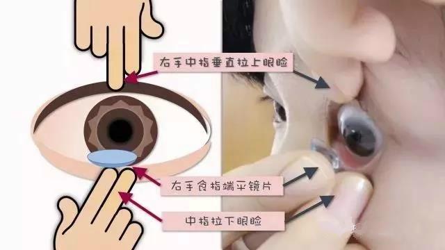 孩子近视增长快？角膜塑形镜的5大好处与3个注意事项